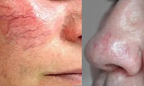 Yüzdeki Damarların Belirgin Olmasının Nedenleri ve Kozmetik Çözüm Yöntemleri