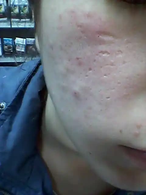 Yüzdeki Delikleri Kapatmanın En Etkili Yöntemleri ve Güncel Çözümler