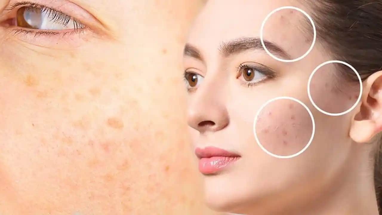 Yüzdeki Güneş Lekelerine Karşı Etkili Koruma ve Tedavi Yöntemleri