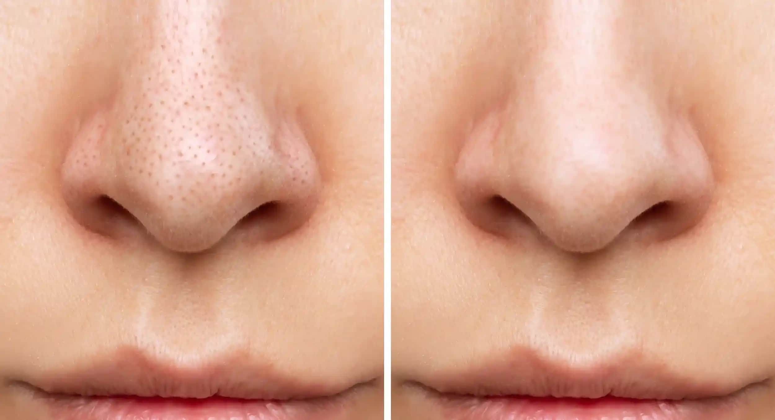 Yüzdeki Kapalı Komedonlar Nasıl Geçer Cilt Sağlığı ve Temizliği Yöntemleri