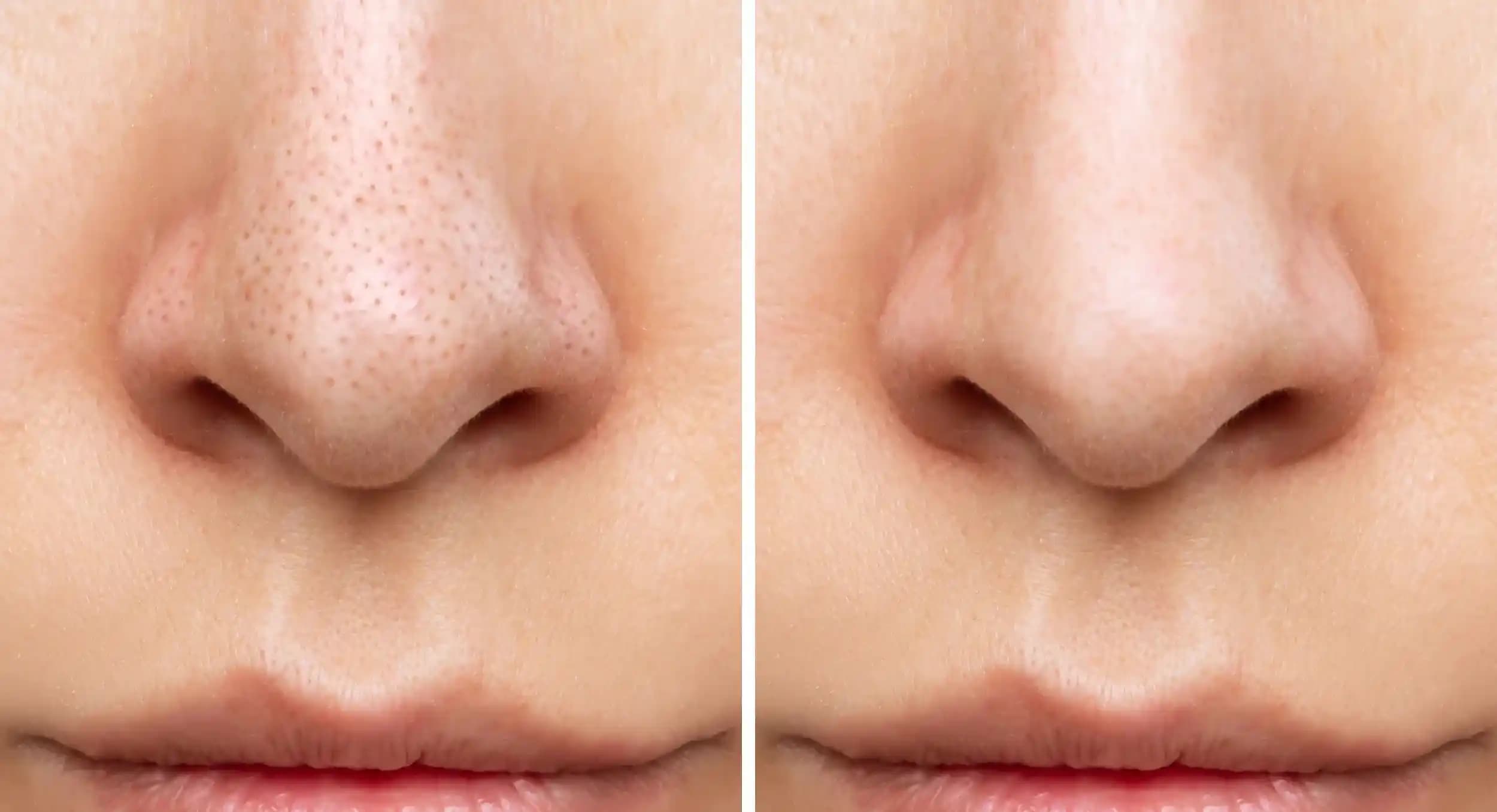 Yüzdeki Kapalı Komedonlar Nasıl Geçer Cilt Sağlığı ve Temizliği Yöntemleri