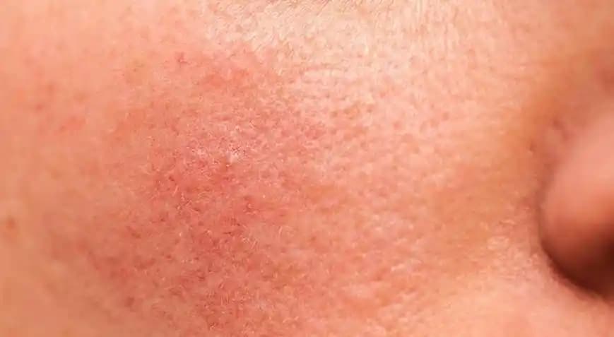 Yüzdeki Kaşıntı ve Kızarıklık Nasıl Geçer: Etkili Doğal ve Medikal Yöntemler