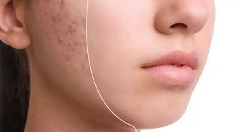 Yüzdeki Kızarıklık Ne Kadar Sürede Geçer ve Hangi Yöntemler Uygulanabilir