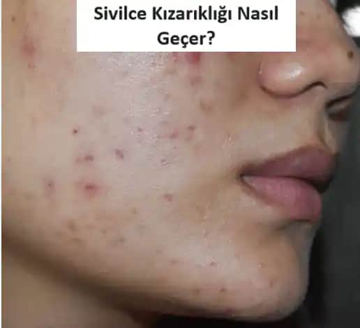 Yüzdeki Kızarıklıkların Nedenleri ve Etkili Tedavi Yöntemleri