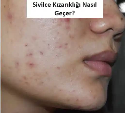 Yüzdeki Kızarıklıkların Nedenleri ve Etkili Tedavi Yöntemleri