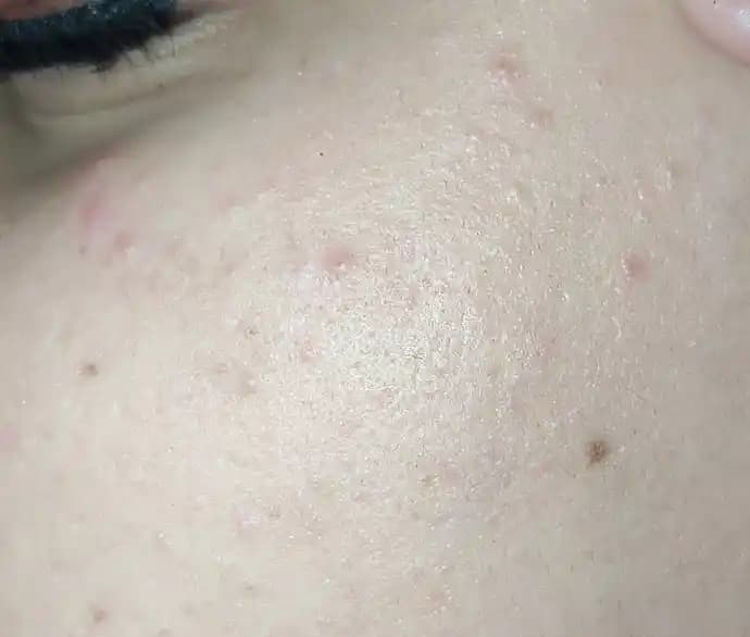 Yüzdeki Küçük Sivilceler: Nedenleri ve Etkili Çözüm Yolları