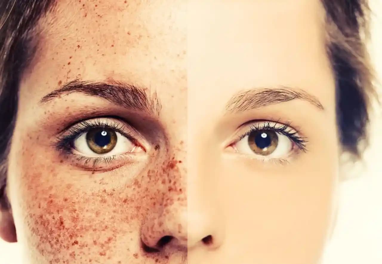 Yüzdeki Lekeleri Gideren Doğal ve Güvenli Evde Uygulanabilir Yöntemler