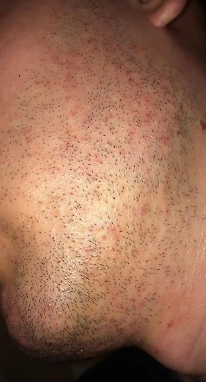 Yüzdeki Minik Sivilcelerin Nedenleri ve Doğal Çözüm Yöntemleri Rehberi