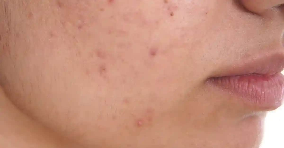 Yüzdeki Sivilce Lekeleri: Nedenleri, Tedavi Yöntemleri ve Doğal Çözümler