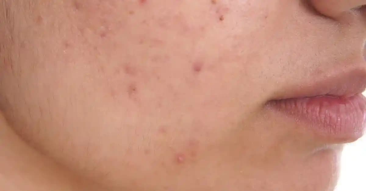 Yüzdeki Sivilce Lekeleri: Nedenleri, Tedavi Yöntemleri ve Doğal Çözümler