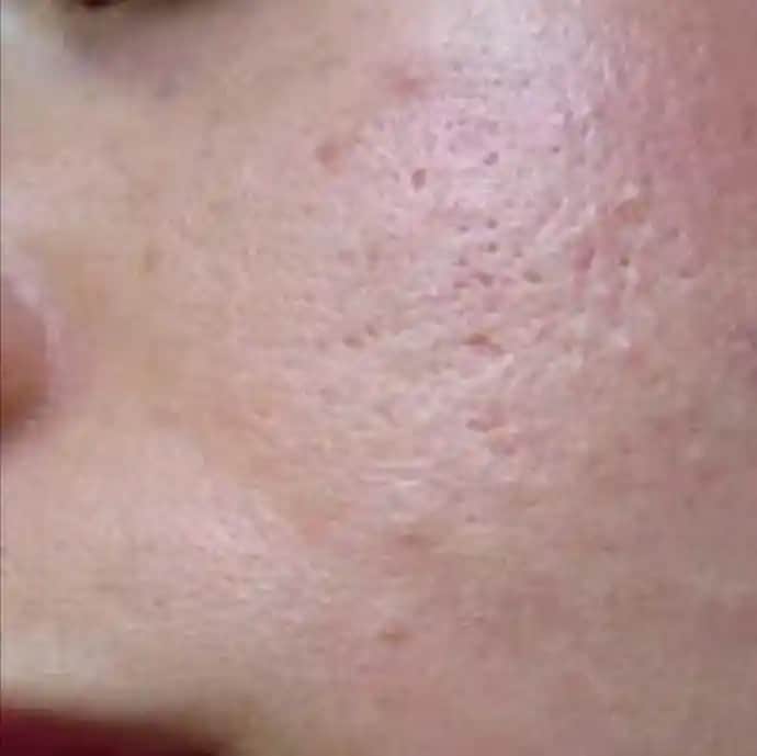 Yüzdeki Sivilce Nedenleri ve Etkili Çözüm Yolları Hakkında Detaylı Bilgi