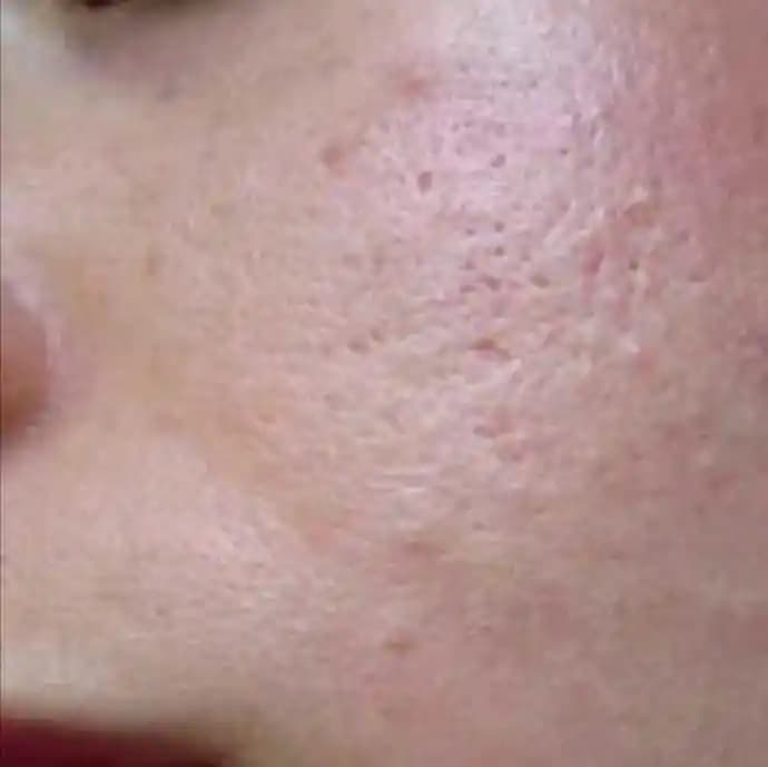 Yüzdeki Sivilce Nedenleri ve Etkili Çözüm Yolları Hakkında Detaylı Bilgi