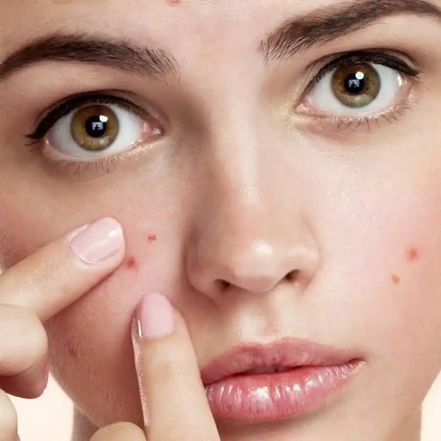 Yüzdeki Sivilce Nedenleri ve Etkili Çözüm Yöntemleri Hakkında Detaylı Bilgi