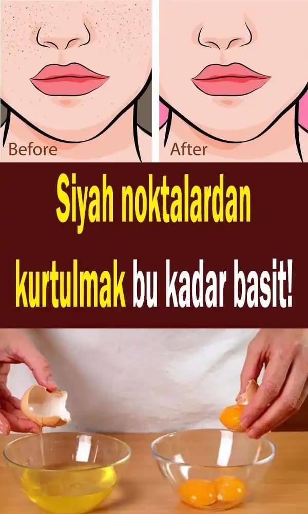 Yüzdeki Siyah Noktaları Evde Doğal Yöntemlerle Giderme Rehberi