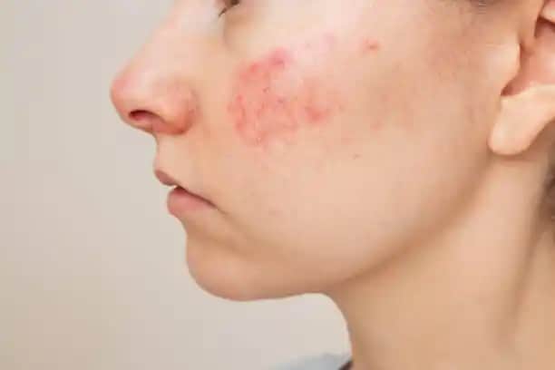 Yüzdeki Tahriş Ne Kadar Sürede Geçer ve Doğru Yaklaşım Nasıl Olmalı