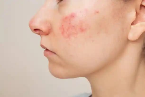 Yüzdeki Tahriş Ne Kadar Sürede Geçer ve Doğru Yaklaşım Nasıl Olmalı