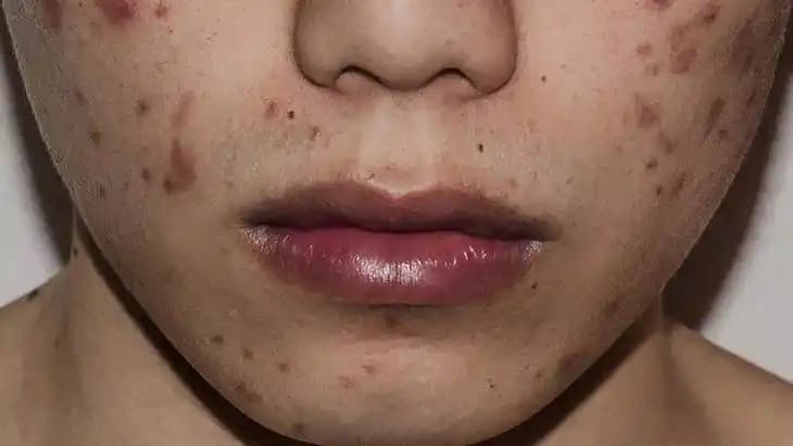 Yüzdeki Yaraların İyileşme Süreci ve Doğru Bakım Yöntemleri Hakkında Bilgiler