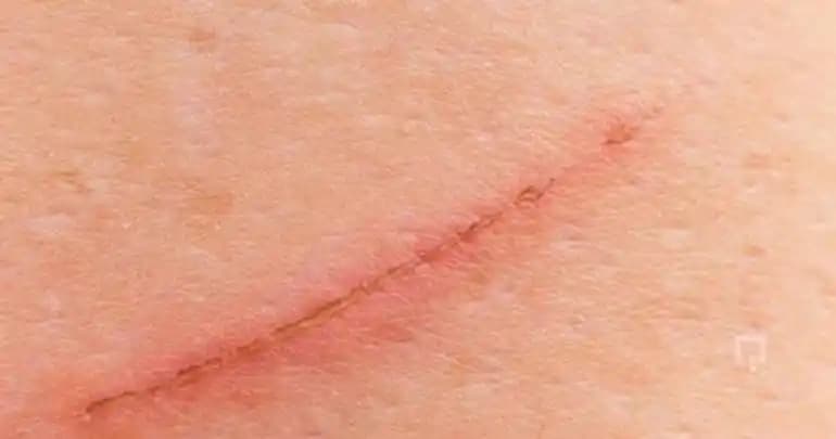 Yüzeysel Tırnak İzi Nedir, Nedenleri ve Etkili Bakım Yöntemleri