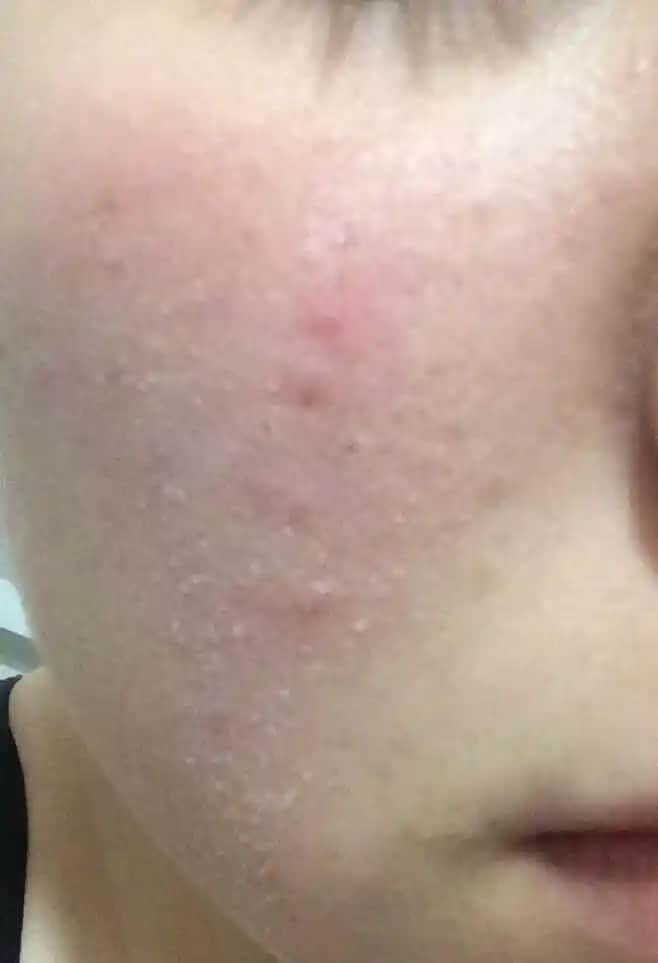 Yüzünüz Çok Kuru Ne Yapmalısınız Cilt Kuruluğu Problemi İçin Kapsamlı Rehber