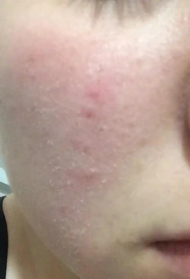 Yüzünüz Çok Kuru Ne Yapmalısınız Cilt Kuruluğu Problemi İçin Kapsamlı Rehber