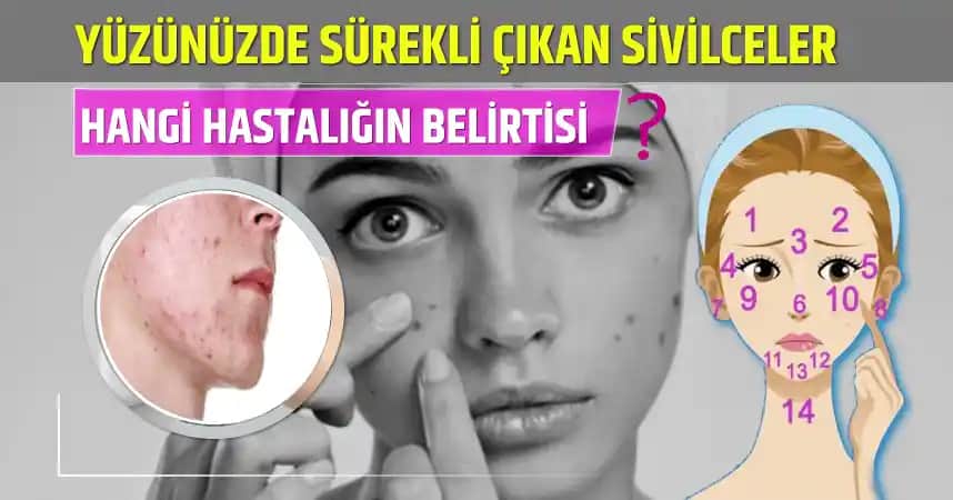 Yüzünüzde Aniden Çıkan Sivilceler: Nedenleri ve Etkili Çözüm Yolları