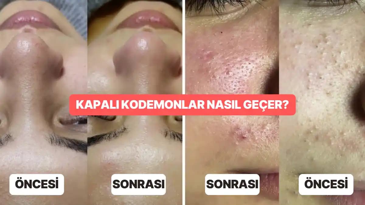 Alındaki Kapalı Komedonların Oluşumu, Tedavi Yöntemleri ve Günlük Bakım İpuçları
