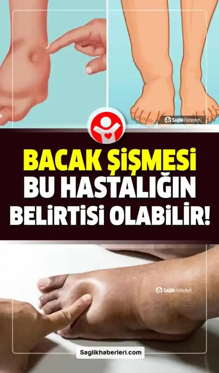 Bacak Terlemesi Nedenleri ve Etkili Çözüm Yöntemleri Hakkında Detaylı Bilgi