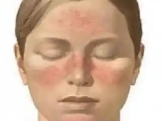 Burun Kızarmasının Nedenleri ve Çözüm Yolları Hakkında Detaylı Bilgi