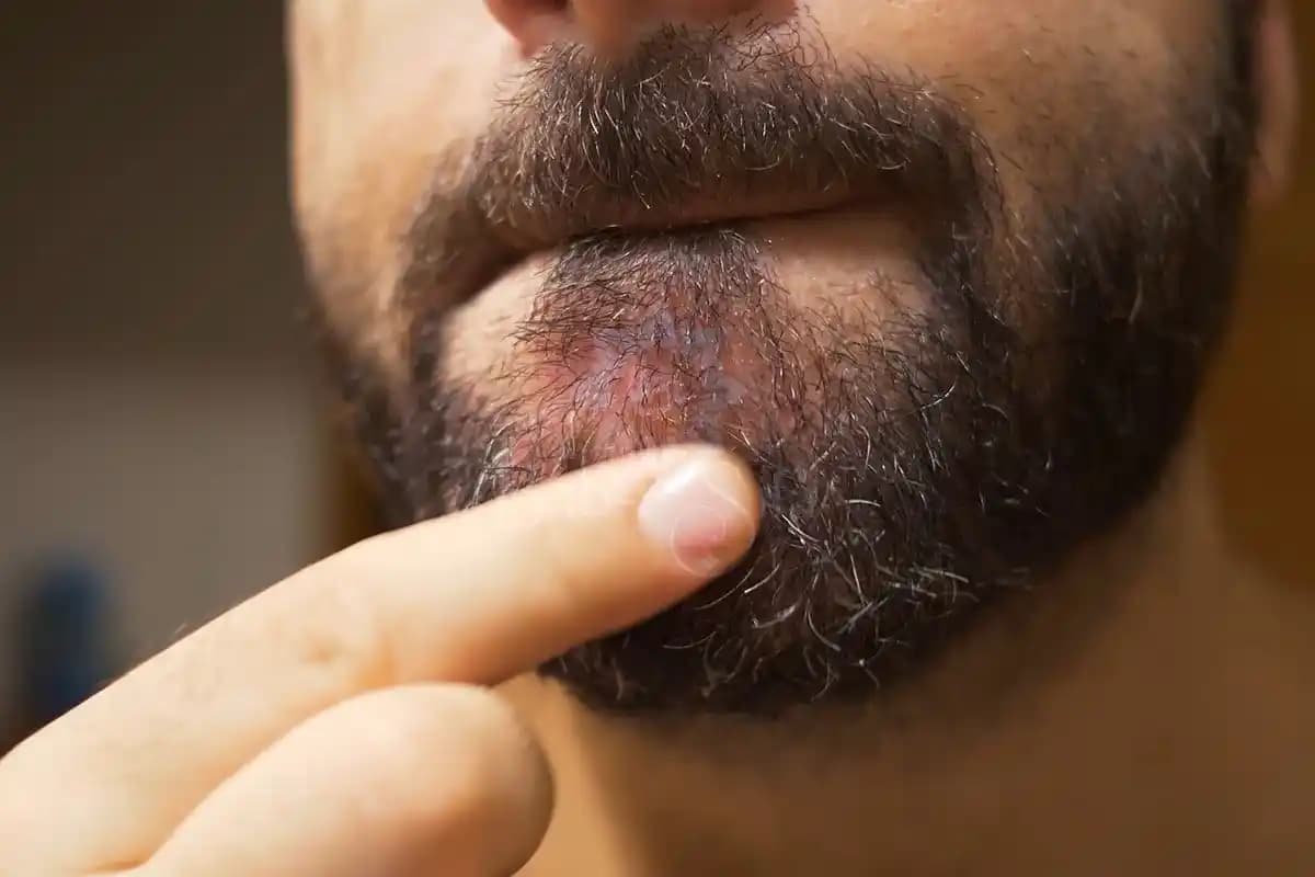 Çenede Kaşıntı Nedenleri ve Kozmetik ile İlgili Önlemler Hakkında Bilgilendirici Rehber