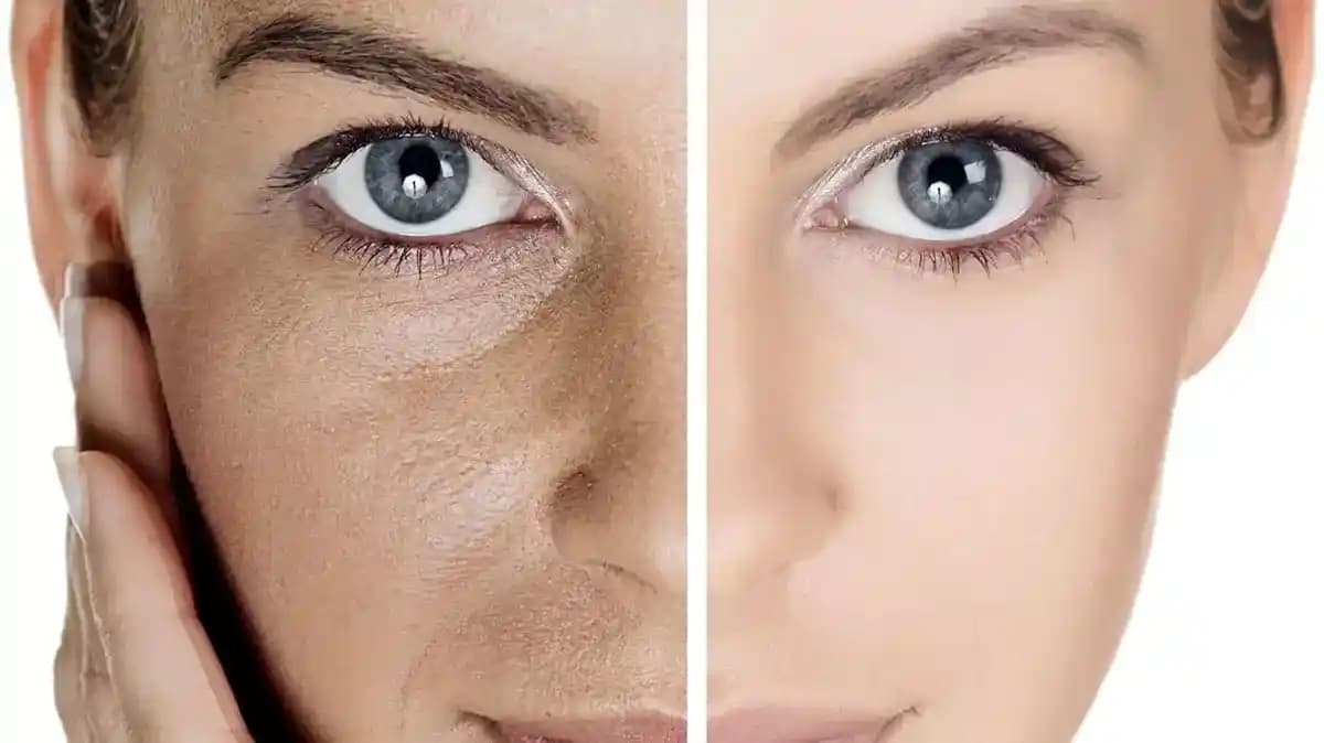 Cilt Kararması Nedir ve Gelişmiş Çözüm Yolları Hakkında Bilmeniz Gerekenler