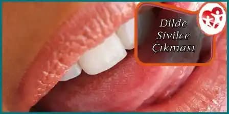 Dilde Beyaz Sivilce Nedenleri, Çözümleri ve Önleyici Yöntemler Hakkında Detaylı Bilgi