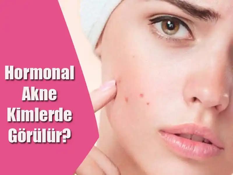 Hormonel Bozuklukların Sivilce Oluşumuna Etkisi ve Tedavi Yöntemleri
