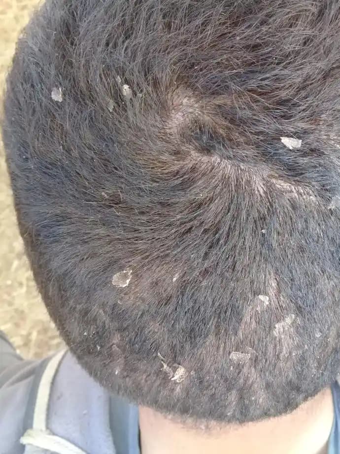 Kafa Derisi Soyulmasının Nedenleri ve Sağlıklı Saç Derisi İçin Alınacak Önlemler