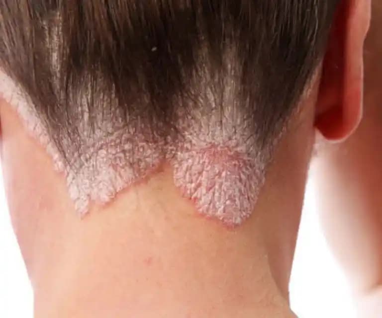 Kafa Derisinde Egzama Nedenleri, Belirtileri ve Etkili Çözüm Yöntemleri