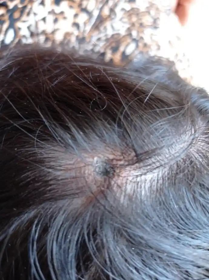 Kafadaki Yaraların Nedenleri ve Güzellik Üzerindeki Etkileri Hakkında Bilgi