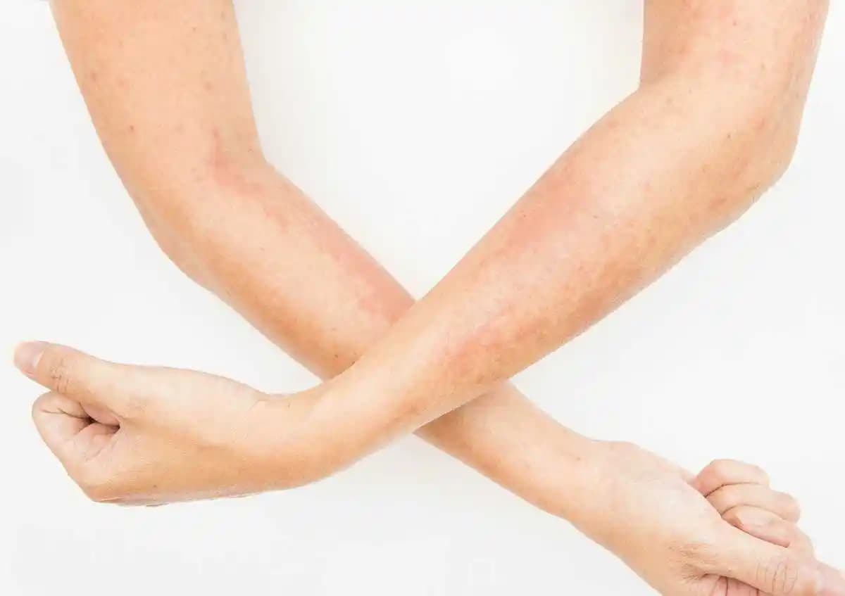 Nikel Alerjisi Belirtileri ve Kozmetik Ürünlerdeki Rolü Hakkında Kapsamlı Bilgi