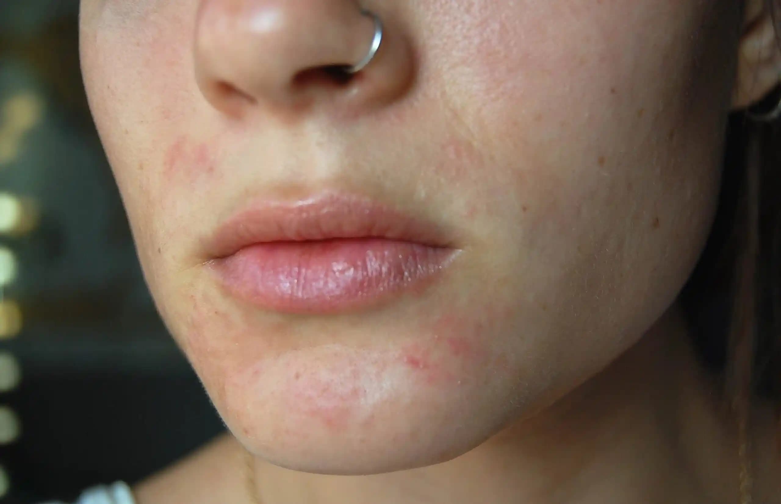 Perioral Dermatitin Güncel Tedavi Yaklaşımları ve Etkili Çözümler Rehberi