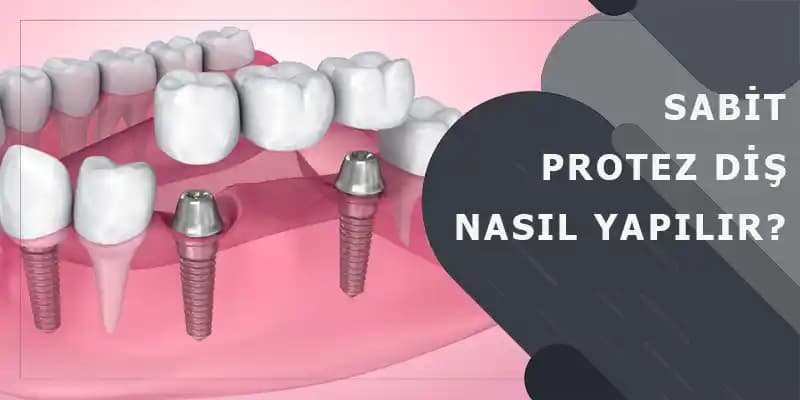 Sabit Protez Diş Yapıştırıcıları: Doğru Seçim ve Uygulama Rehberi