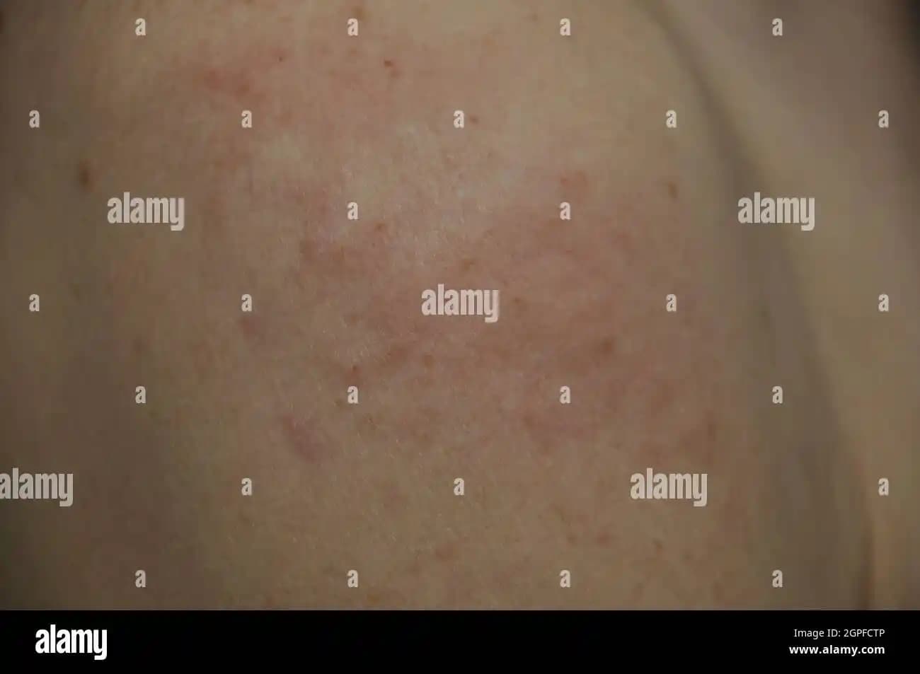 Saç Bakım Ürünleri ve Egzama: Doğru Seçimlerle Cilt Sağlığını Koruma Rehberi