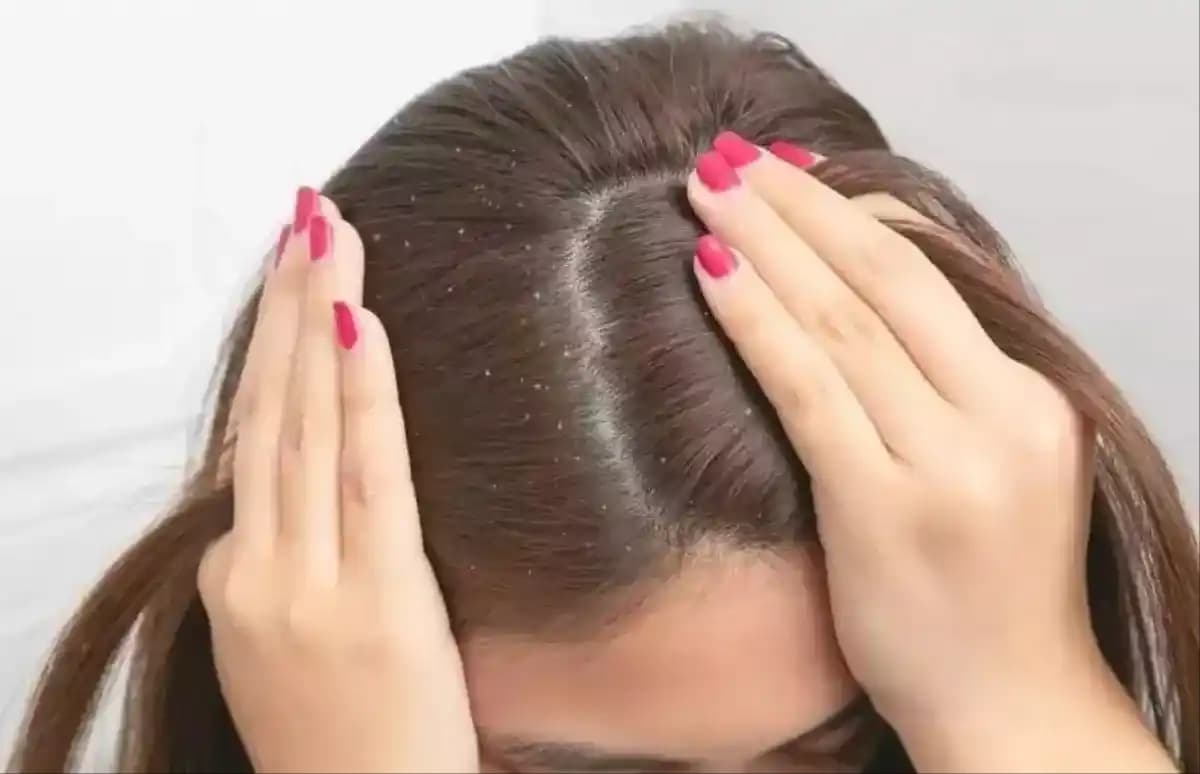 Saç Derisinde Kepek ve Kaşıntı: Nedenleri, Tedavi Yöntemleri ve Bakım İpuçları