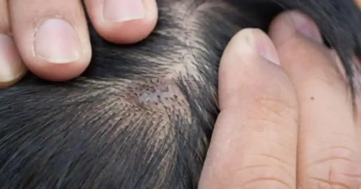 Saç Diplerinde Yara Nedenleri ve Etkili Tedavi Yöntemleri Hakkında Bilmeniz Gerekenler