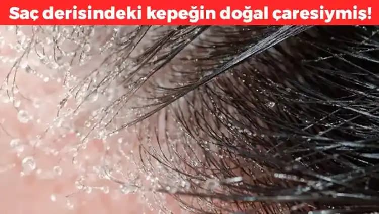 Saç Diplerindeki Egzamaya Karşı Etkili Çözüm Yolları ve Doğal Tedavi Seçenekleri