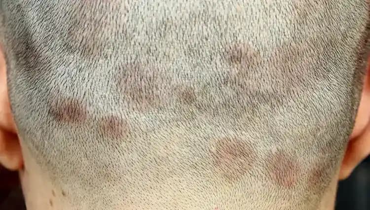 Saç Diplerindeki Sivilce Nedenleri ve Etkili Çözüm Yöntemleri Hakkında Detaylı Rehber