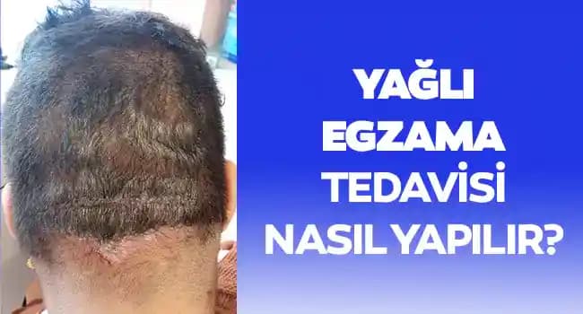 Saçta Egzama Nedir, Belirtileri, Nedenleri ve Etkili Bakım Yöntemleri