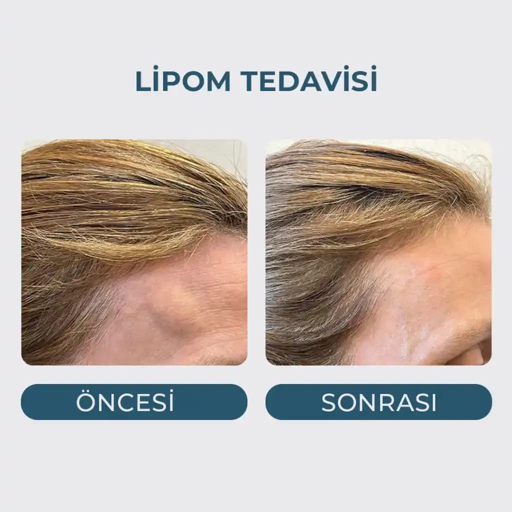 Saçta Yağ Bezesine Dair Her Şey: Tanımından Tedavisine Geniş Kapsamlı Bilgi