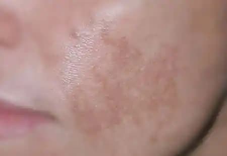 Siyah Lekelerle Mücadele: Nedenleri, Çözüm Yöntemleri ve Kozmetik Alternatifler