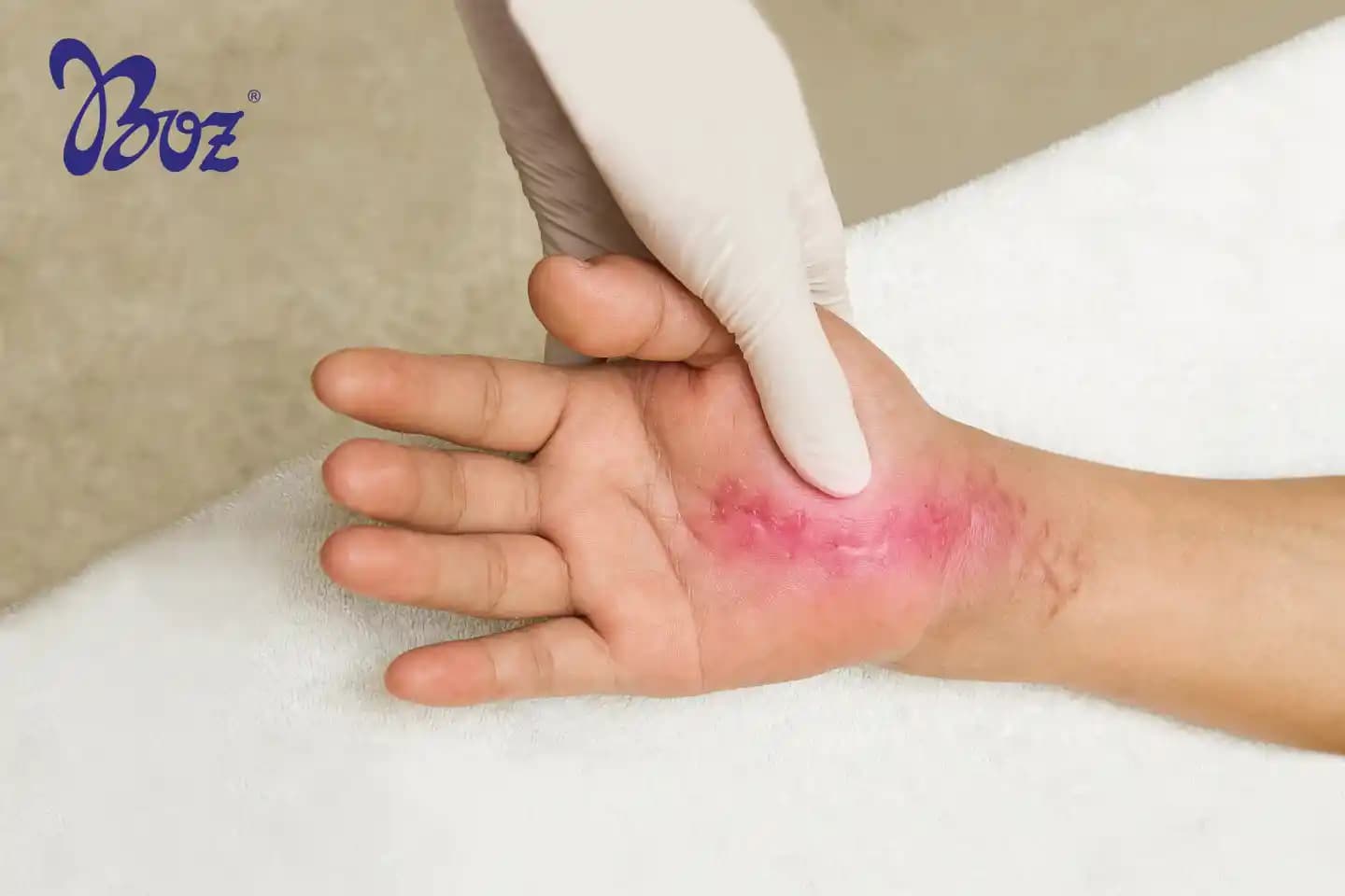 Sıyrık Yaralarına Doğru Bakım ve Tedavi Yöntemleri Hakkında Detaylı Bilgi