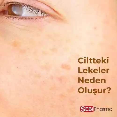 Vücutta Siyah Lekelerin Nedenleri ve Tedavi Yöntemleri Analizi