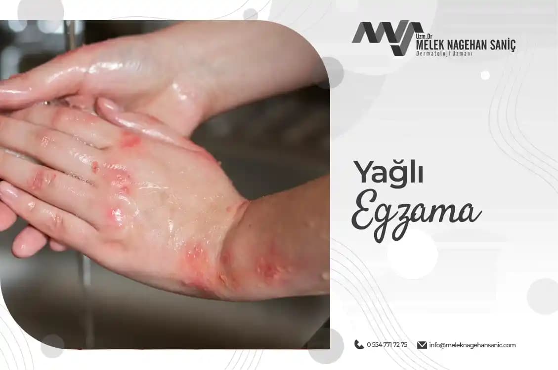 Yağlı Egzama Nedir Belirtileri Nedenleri ve Tedavi Yöntemleri Hakkında Detaylı Bilgi