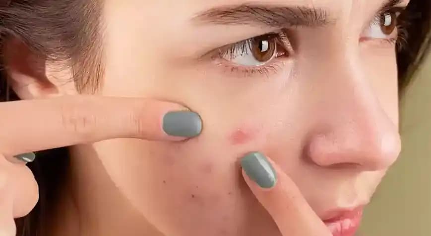 Yanakta Sivilce Çıkmasının Nedenleri ve Etkili Çözüm Yolları